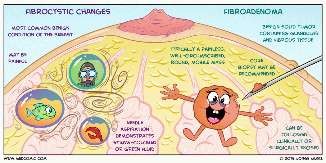 Educational medical illustration comparing fibrocystic changes (benign breast condition with fibrous and cystic changes, common in women 30-50) and fibroadenoma (most common benign breast tumor in women under 30, presenting as a painless mobile mass), including fine-needle aspiration and diagnostic workup