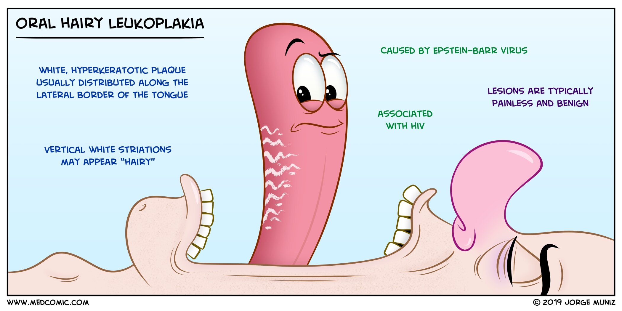 Educational medical illustration of oral hairy leukoplakia caused by Epstein-Barr virus (EBV), showing white hyperkeratotic plaques with vertical striations along the lateral border of the tongue, commonly associated with immunocompromised states including HIV