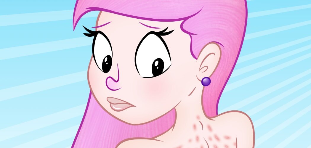 Pityriasis Rosea