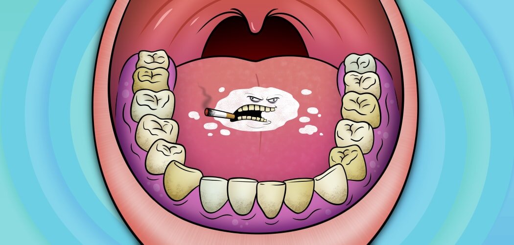 Leukoplakia vs. Oral Candidiasis