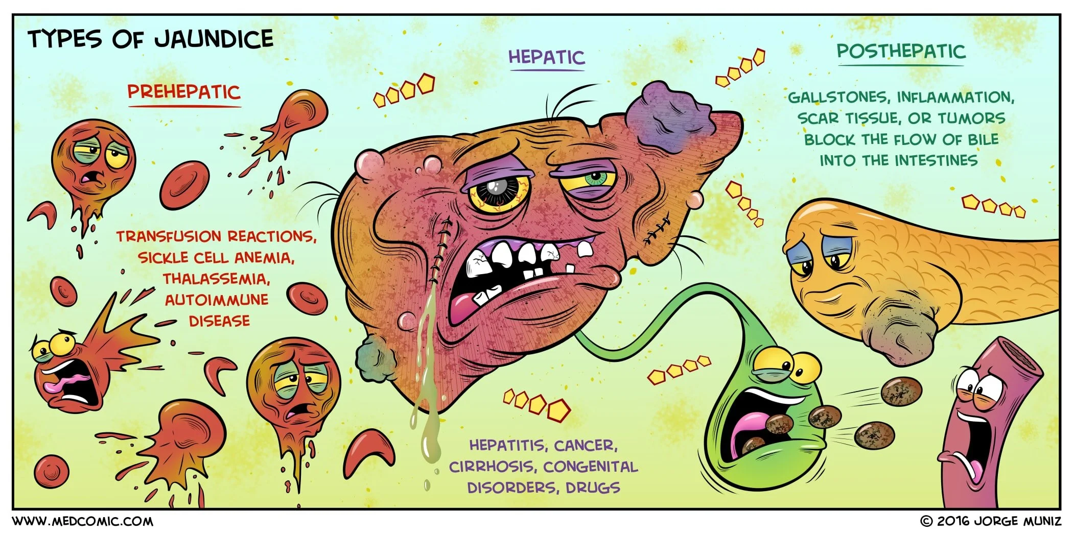 Educational medical illustration of the three types of jaundice: prehepatic (hemolytic) jaundice with elevated unconjugated bilirubin from RBC lysis, hepatic jaundice with hepatocyte dysfunction causing both conjugated and unconjugated bilirubin elevation, and posthepatic (obstructive) jaundice with conjugated bilirubin accumulation from bile duct obstruction